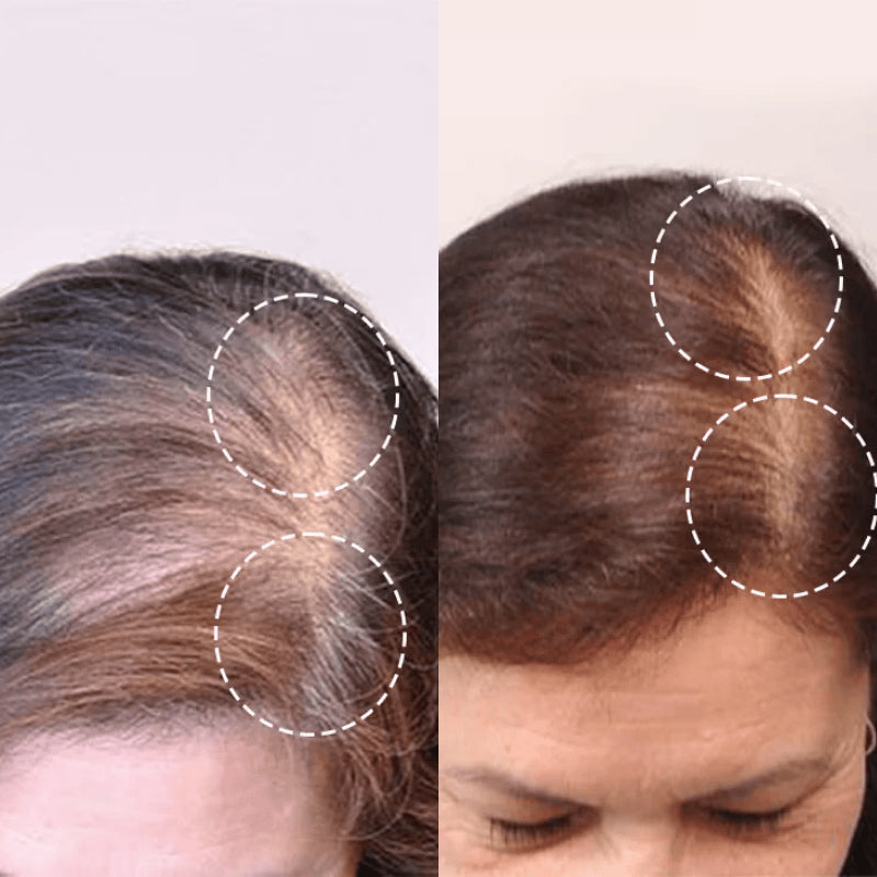 KomeeSol Red Light Therapy Hair Growth Scalp Massager UK
