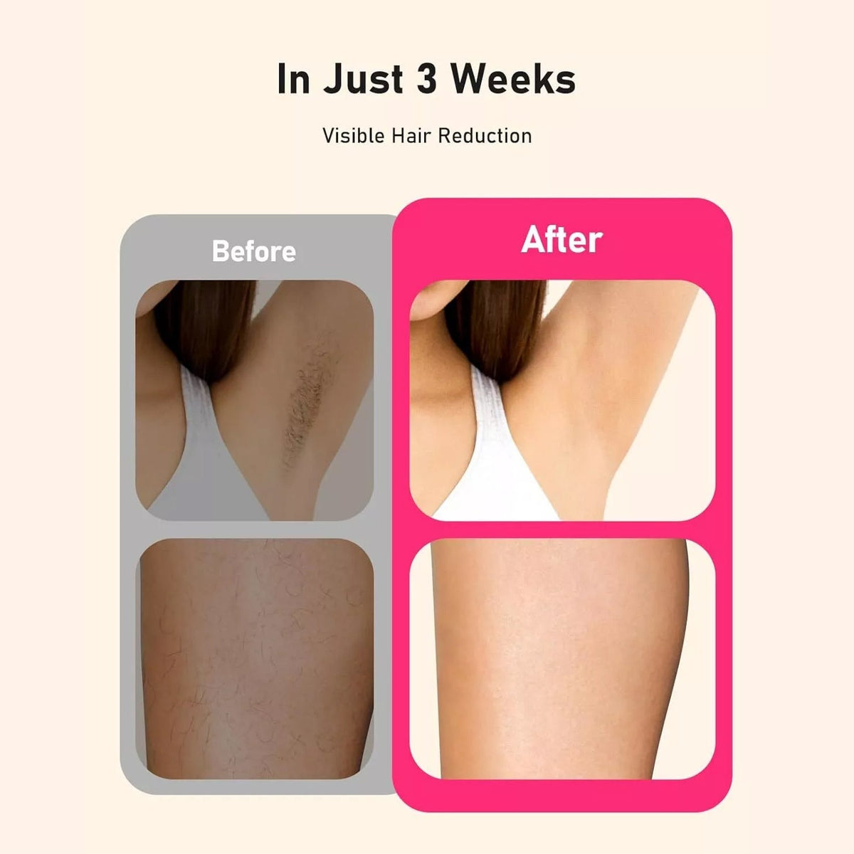 Purelazor At-Home Laser Hair Removal Device for Dark Skin
