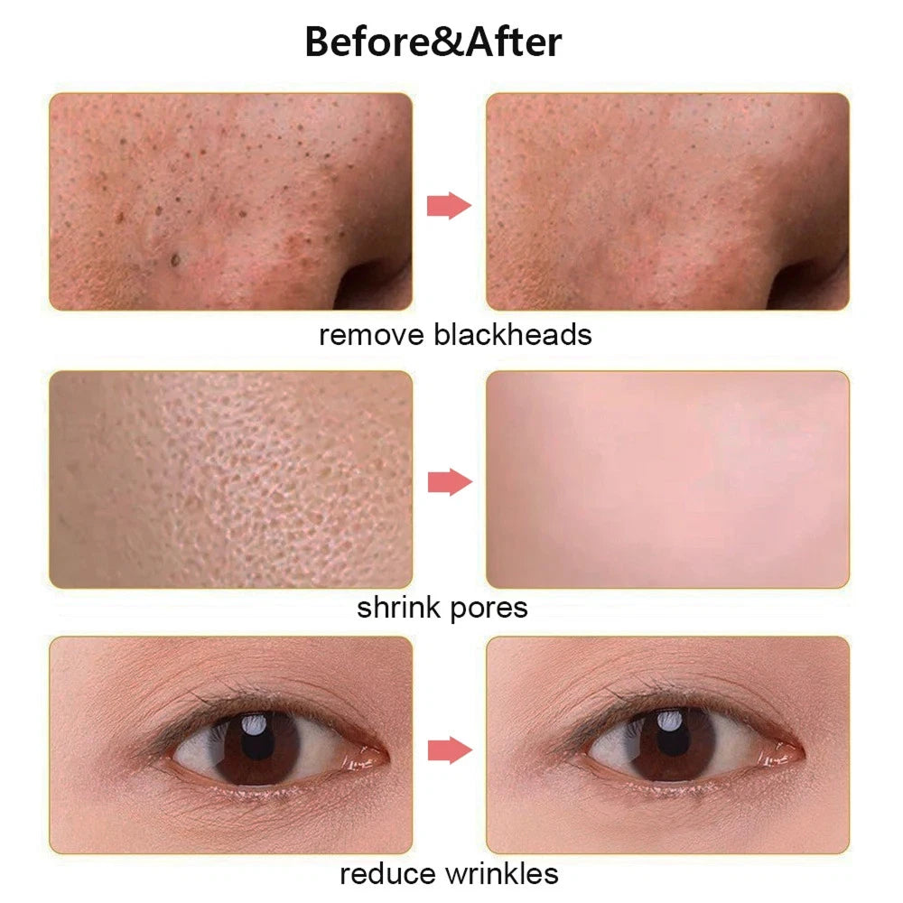 SkinSonyc Ultrasonic Skin Scrubber for Deep Pore Cleansing & Firming