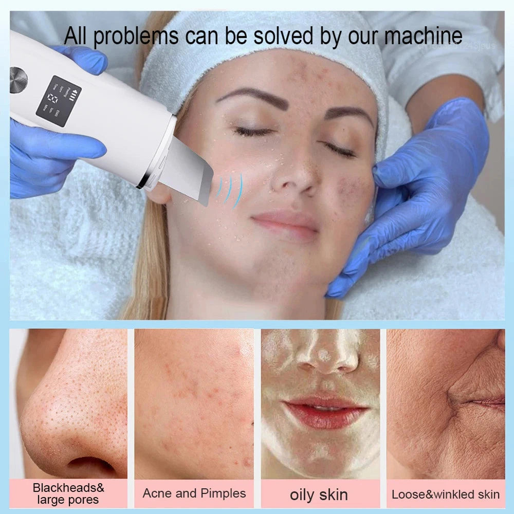 SkinSonyc Ultrasonic Skin Scrubber for Deep Pore Cleansing & Firming