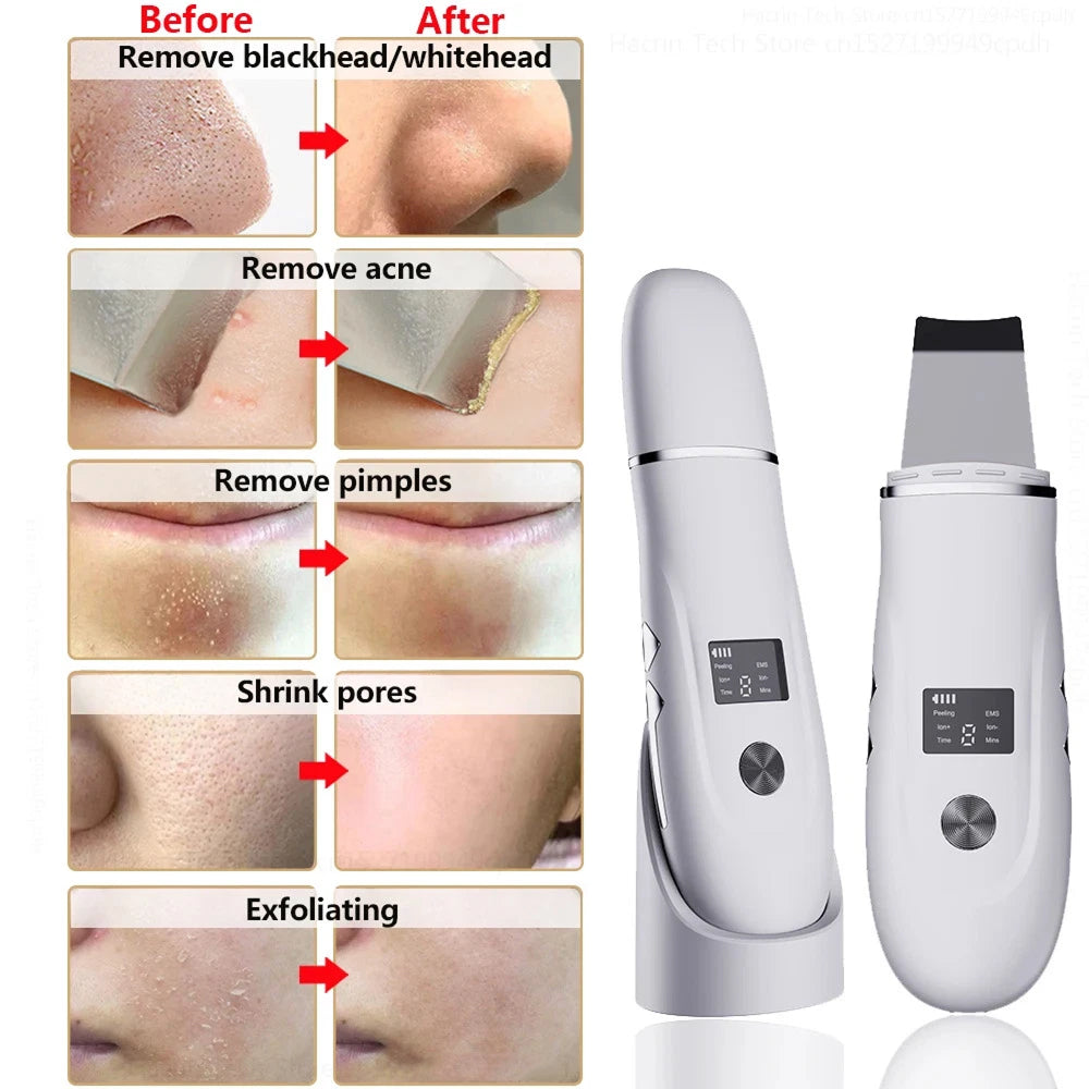 SkinSonyc Ultrasonic Skin Scrubber for Deep Pore Cleansing & Firming